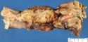 Crohn ileitis