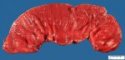 Intestinal segmental dilatation upon a peritoneal adherence