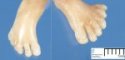 Posta-axial hexadactyly in a Meckel syndrome