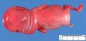 Left limb hypoplasia in a 18 weeks fetus