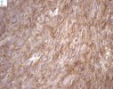 EMA (Epithelial Membrane antigen)