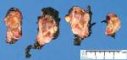 Adrenal neuroblastoma (post-chemotherapy appearance)