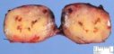 clear cell myomelanocytic tumor of falciform ligament