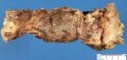 Crohn ileitis