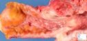 Crohn ileitis