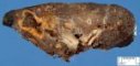 Bronchectasias in cystic fibrosis