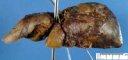 Hepatic ischemia in a liver allograft