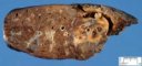 Bronchiectasis in cystic fibrosis