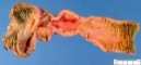 Crohn ileitis