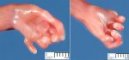 Post-axial polydactyly in Meckel syndrome