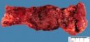 Crohn ileitis
