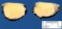 Cutaneous juvenile xanthogranuloma (after formalin fixation)