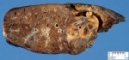 Bronchiectasis in cystic fibrosis