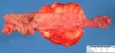 Mesenteric lipoma