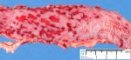 Idiopathic inflammatory colitis