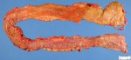 Colonic adenomatous polyposis