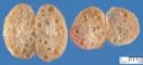 Renal dysplasia in Meckel syndrome (15 weeks)