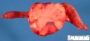 Mesenteric lipoma