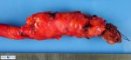 rhabdomyosarcoma of the ureter