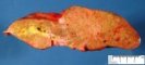 Dilatation of large bile ducts in extrahepatic biliary tract (...)