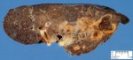 Bronchectasias in cystic fibrosis