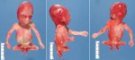 Caudal regression syndrome with lumbosacral agenesis and situs (...)
