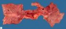 Ileocecal region with Crohn ileitis