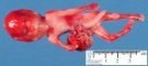 Omphalocele-radial ray aplasia association