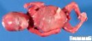 Megacystis with abdominal distension by urethral obstruction