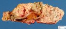 Acute necrotizing pancreatitis