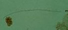 Microfilaria of Onchocerca volvulus, from skin snip.