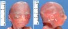 Prominent eyes, hypertelorism, retrognathia, intra-uterine growth (...)