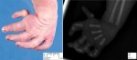 First metacarpal severe hypoplasia
