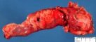 Crohn ileitis