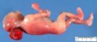 Posterior encephalocele