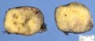 clear cell myomelanocytic tumor of falciform ligament