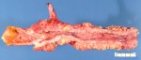 Crohn ileitis