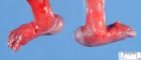 Rocker-bottom feet (22 weeks)