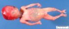 Tetraectrodactyly in a fetus