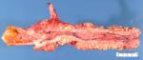 Crohn disease. Ileocaecal junction.