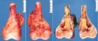 Femoral osteosarcoma