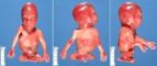 Caudal regression syndrome with lumbosacral agenesis