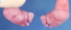 foot 1-2 syndactyly