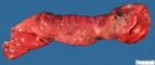 Intestinal segmental dilatation upon a peritoneal adherence