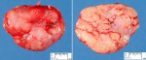 Classical Hodgkin lymphoma type nodular sclerosing
