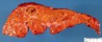 Macronodular cirrhosis and hepatocellular carcinoma in tyrosinemia