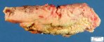 Acute necrotizing pancreatitis