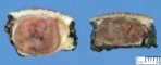 Lobular capillary hemangioma