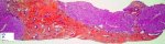 Ductal plate malformation (congenital hepatic fibrosis)