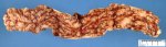 Ileal Crohn disease